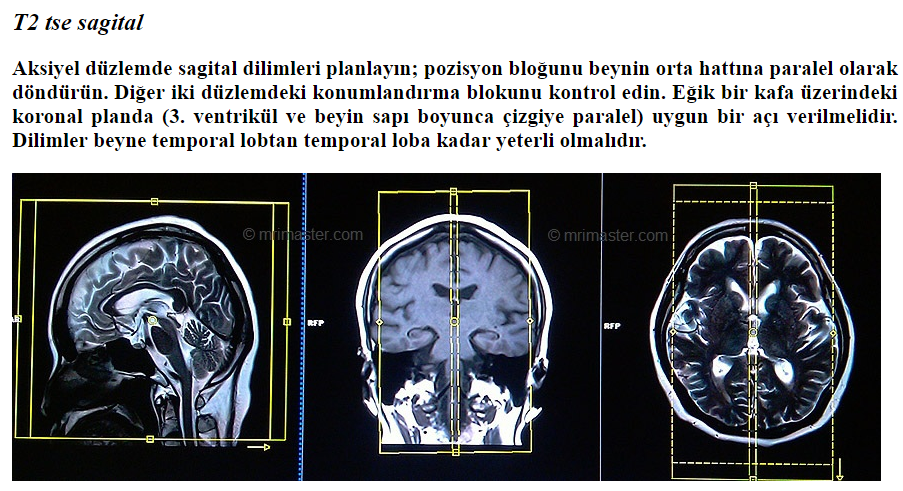 Radyoloji Beyin Mr Cekimi