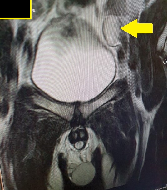 Undescended Testes MRI Sumer's Radiology Blog