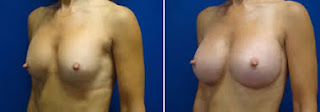 Augmentation mammaire avant après pour femme