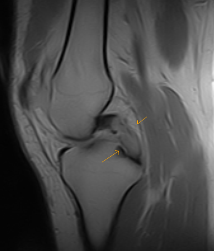 PCL Mucoid Degeneration-MRI - Sumer's Radiology Blog
