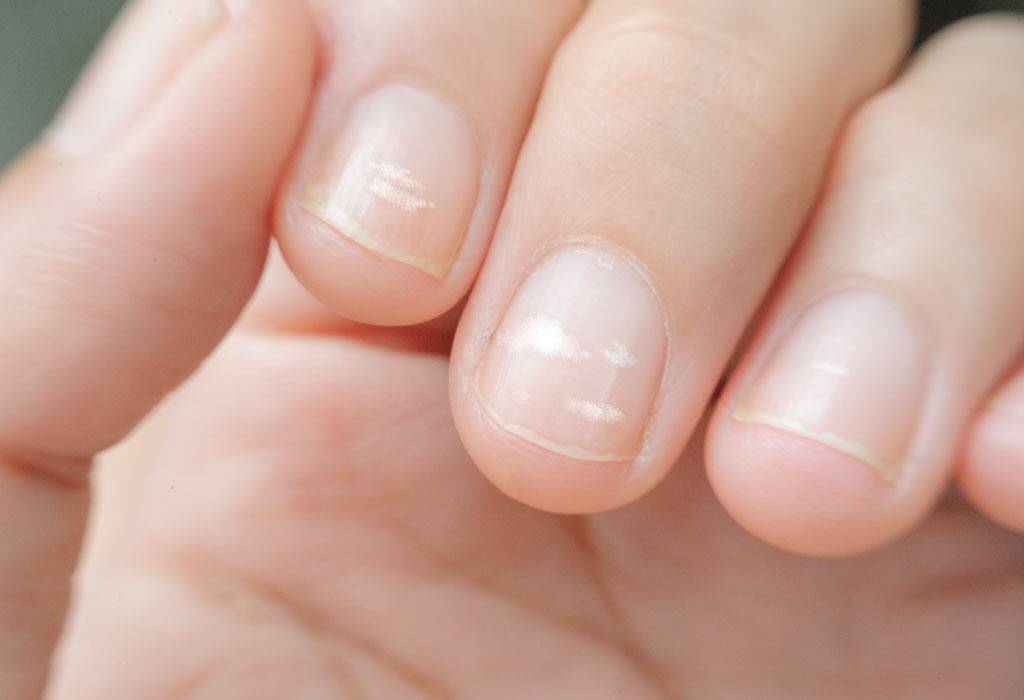 Why the white spots on the nails occur?