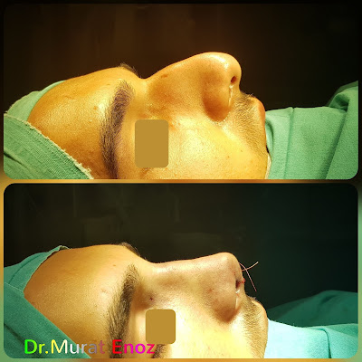 Nose job in men,Rhinoplasty in Men Istanbul,Male nose aesthetic surgery In Turkey,
