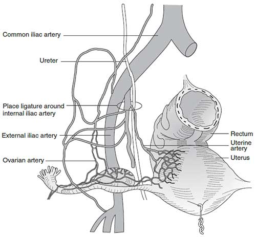 Surgical Management of Postpartum Hemorrhage