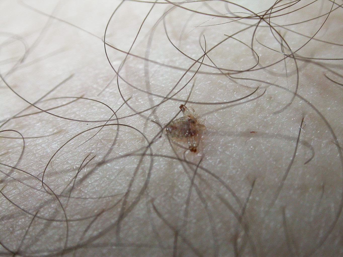 дерматит высыпания в паховой области лечение фото