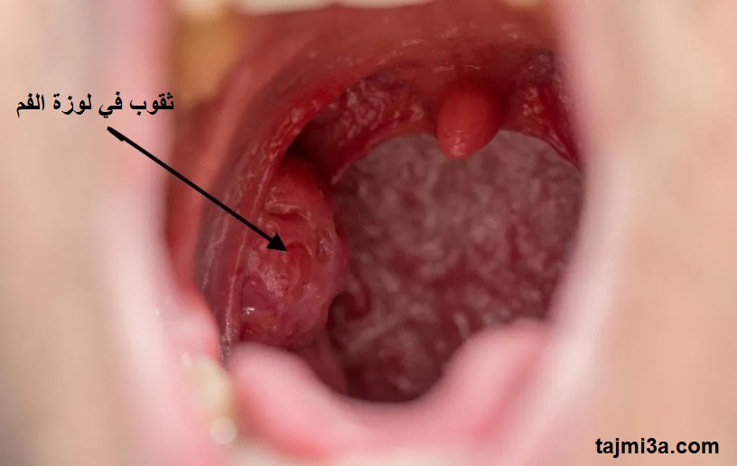 tonsil rot