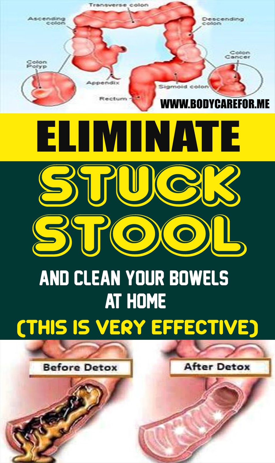 Take out Stuck Stool and Clean Your Bowels At Home!!!