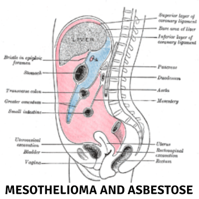 Mesothelioma and Asbestose