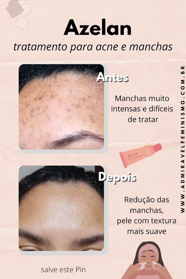 Admirável Feminismo: Resenha Azelan - Ácido Azelaico para tratamento de