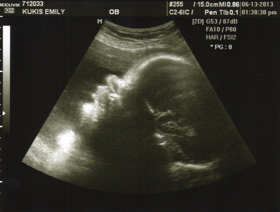 Gracie Ann Ultrasound update 35 weeks