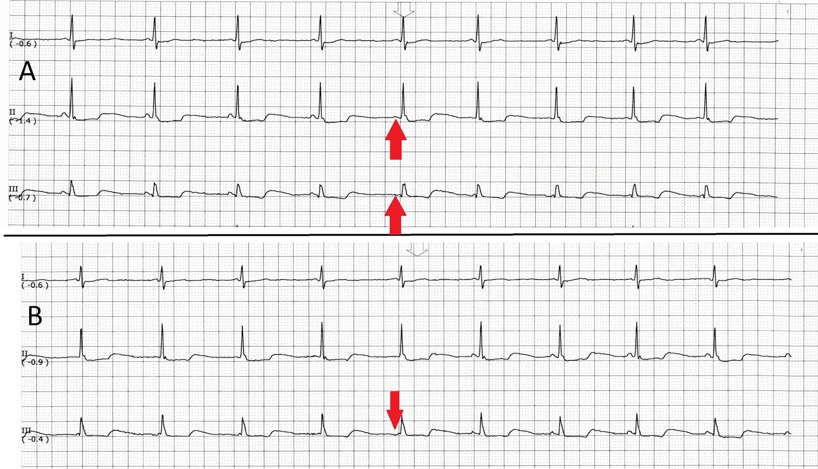 the wandering atrial pacemaker