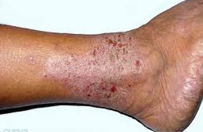 Foto Bahan Alami Mengobati Penyakit Kulit Leher, kepala, kaki, siku Bersisik atau Berkerak ??