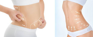 Liposuction Surgery In Lahore by the best plastic surgeon in lahore