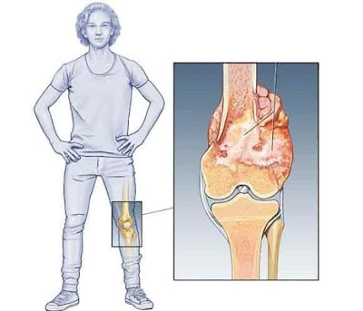 chondrosarcoma bone cancer