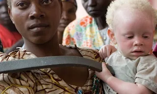Abandoned baby with albinism in Tanzania being cared for by a kind stranger