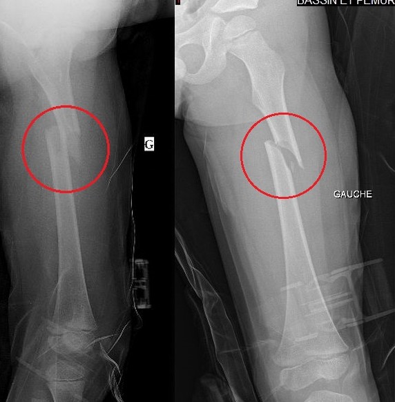 Un Jour En Chirurgie Orthopedique Et Traumatologique Fracture diaphysaire déplacée du fémur de