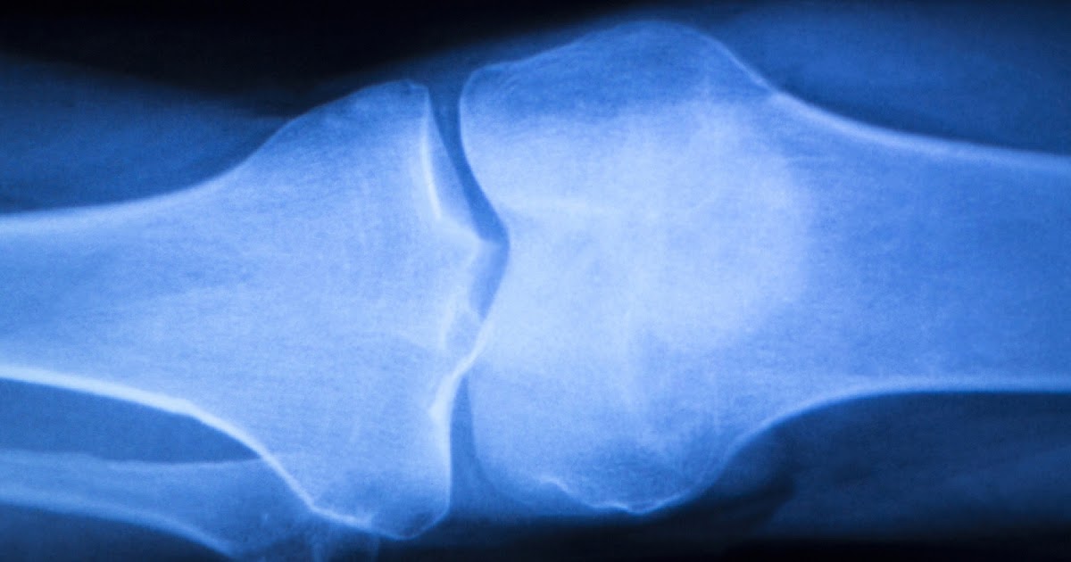 MCL Anatomy, Biomechanics & Injury Science