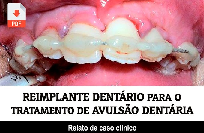 PDF: REIMPLANTE DENTÁRIO para o tratamento de Avulsão Dentária: relato de caso clínico 