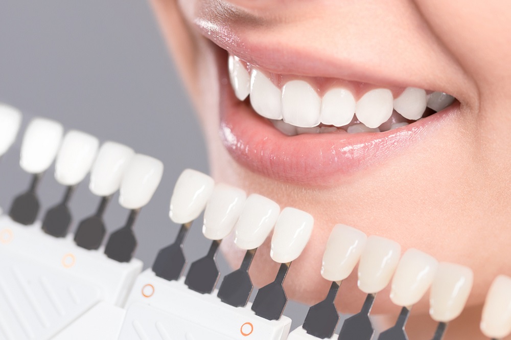 Introducing Bioclear, an Alternative to Porcelain Veneers