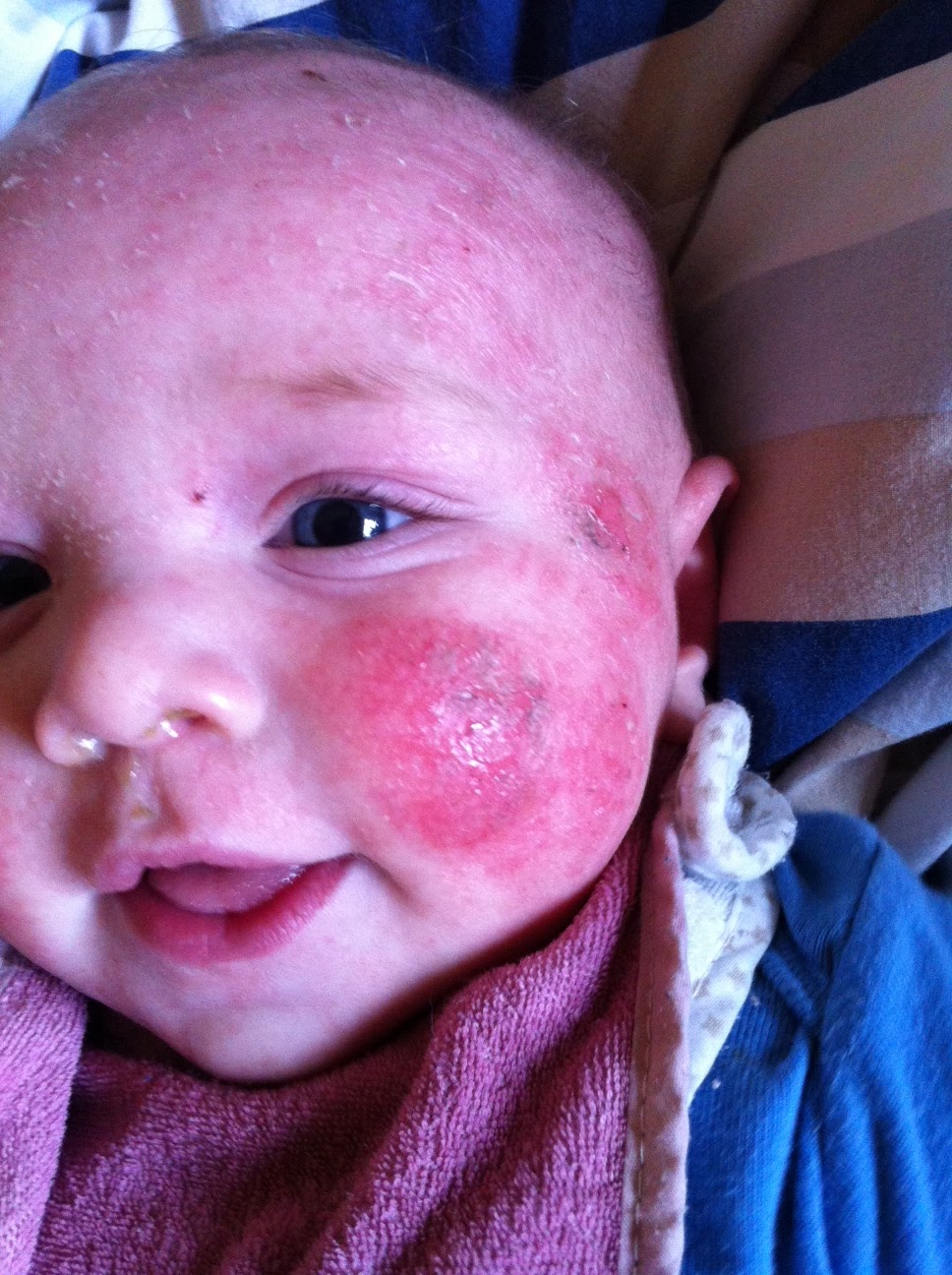 The Reality of a Perfect Life Infantile Eczema/ Baby Lactose