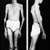 Marfan syndrome: The defect of connective tissue