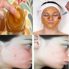 Using Honey for Acne Treatment - Honey Benefits