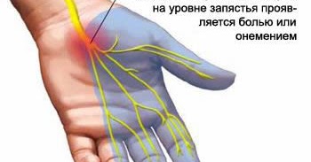 Повреждение локтевого нерва при переломах костей Повреждение локтевого нерва при переломах костей thumbnail