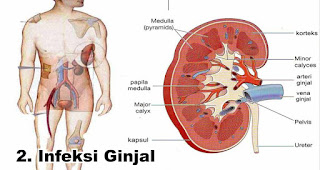 Infeksi Ginjal akibat sering Menahan buang air kecil