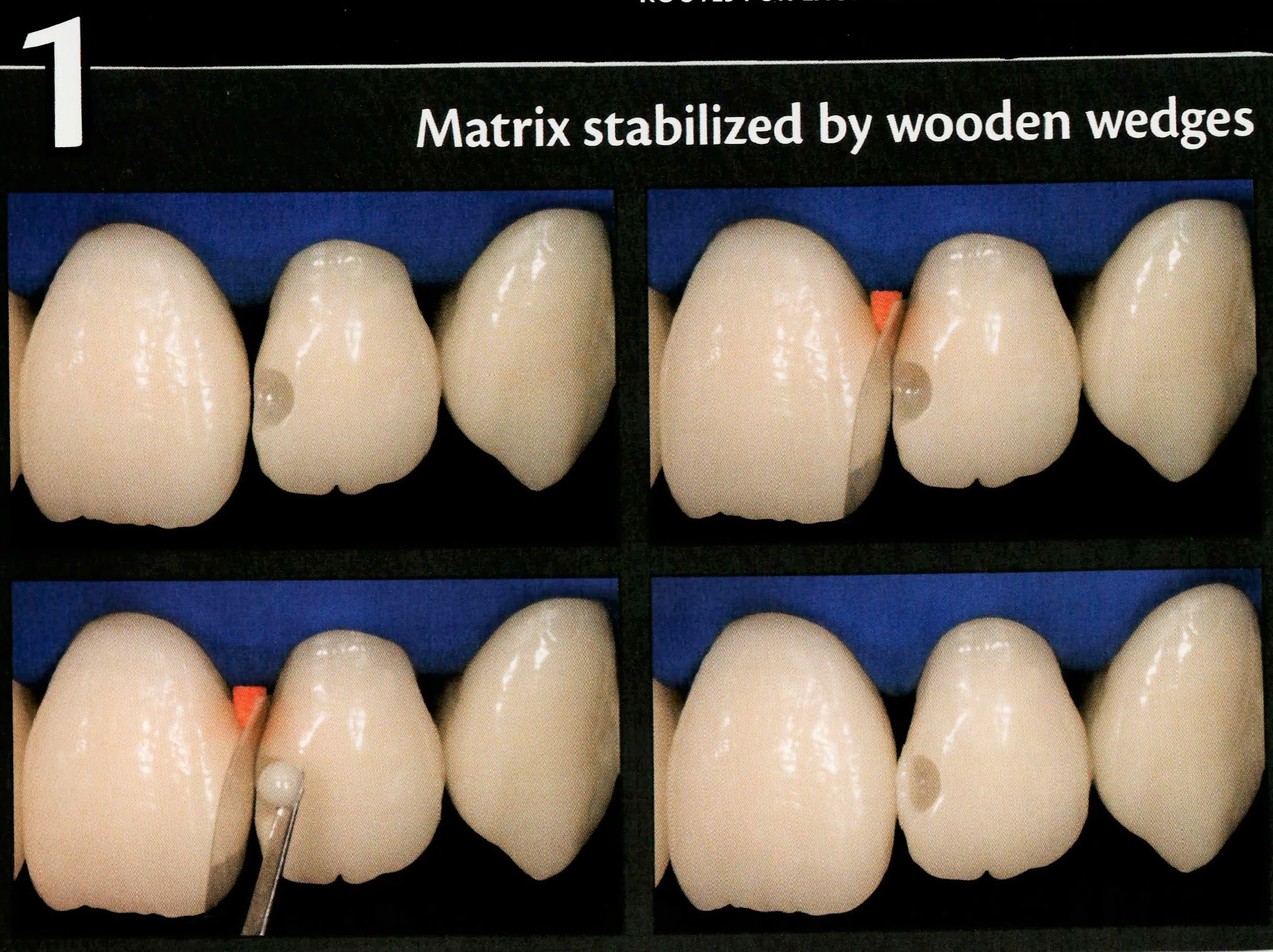 Dental Esthetics Class III Composite Restoration Labial