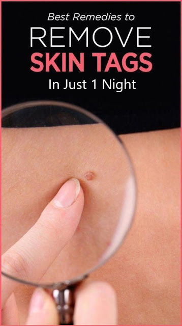How to Remove Skin Tag in 1 Night