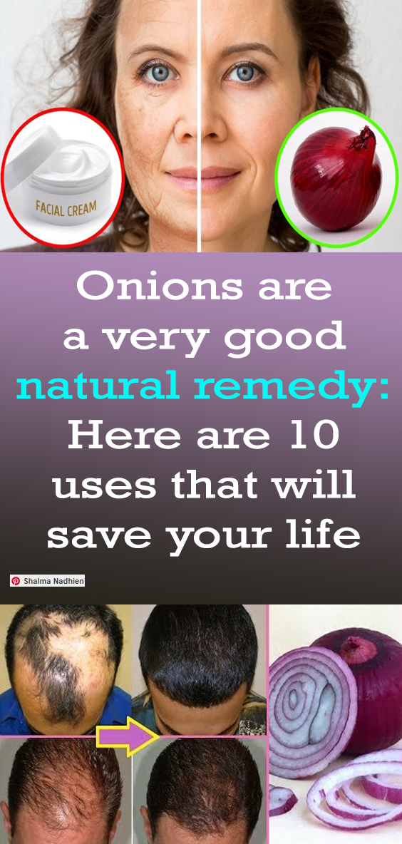 Onions are a very good natural remedy Here are 10 uses that will save
