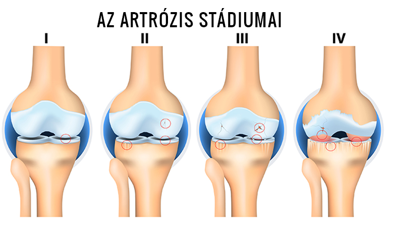 paracetamol az artrózis kezelésében