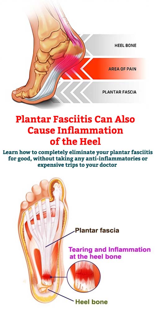 Fast and effective solution for painful heels Plantar Fasciitis Can