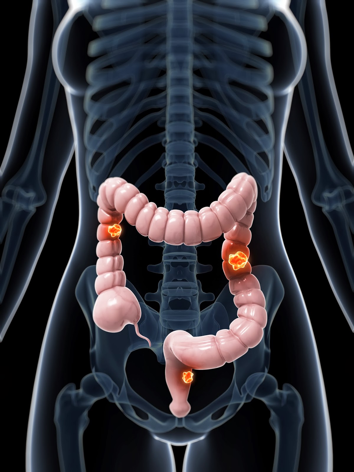 SALUTARIS MEDICAL CENTER: ¿Que es una colonoscopía?