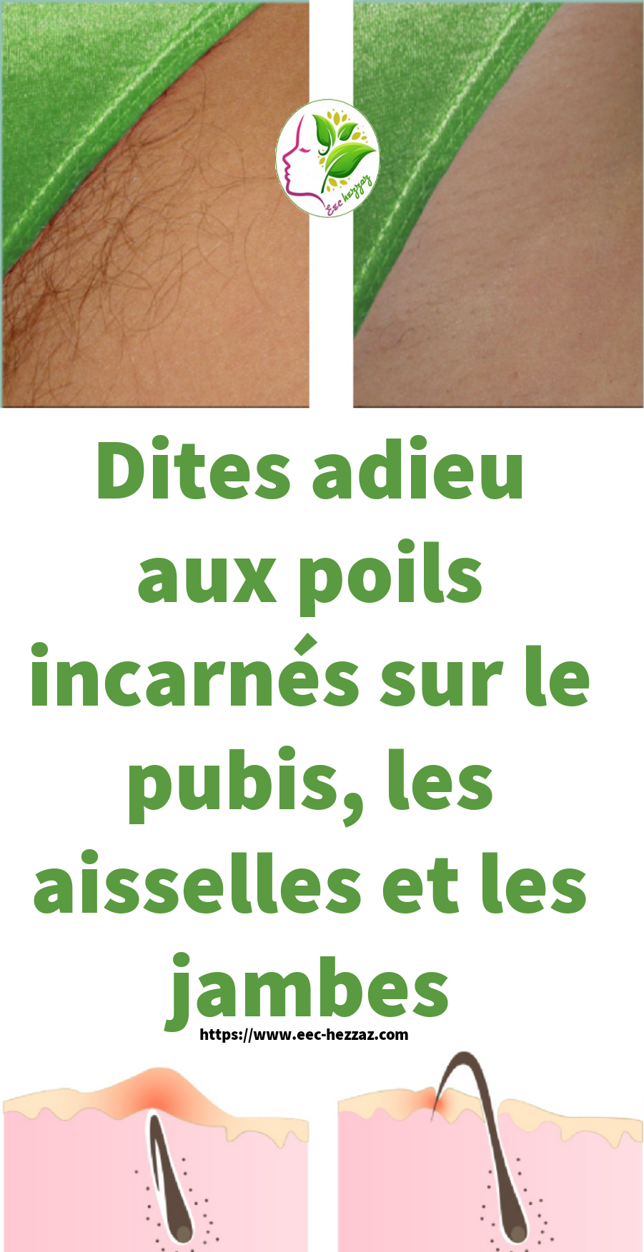 Dites adieu aux poils incarnés sur le pubis, les aisselles et les jambes