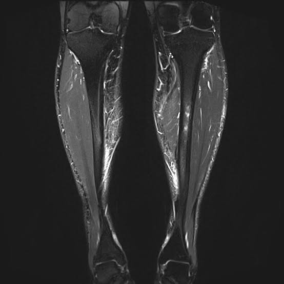 Why do Shin Splints happen