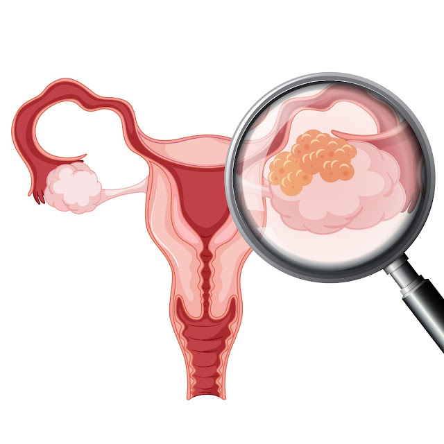 How is Ovarian Cyst Surgery Performed