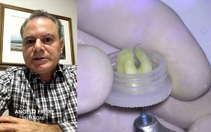 ENDODONTIA: Limpeza do forame sem transporte - Angelo Freire