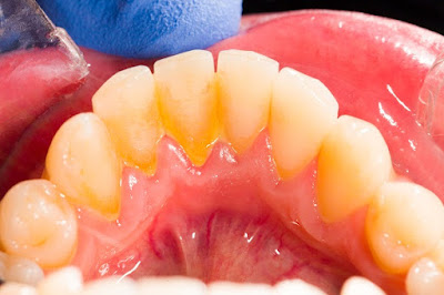 Nhiễm trùng nướu răng là bệnh gì?