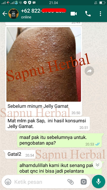Obat Gatal Akibat Jamur Di Selangkangan yg TERBUKTI Manjur!!