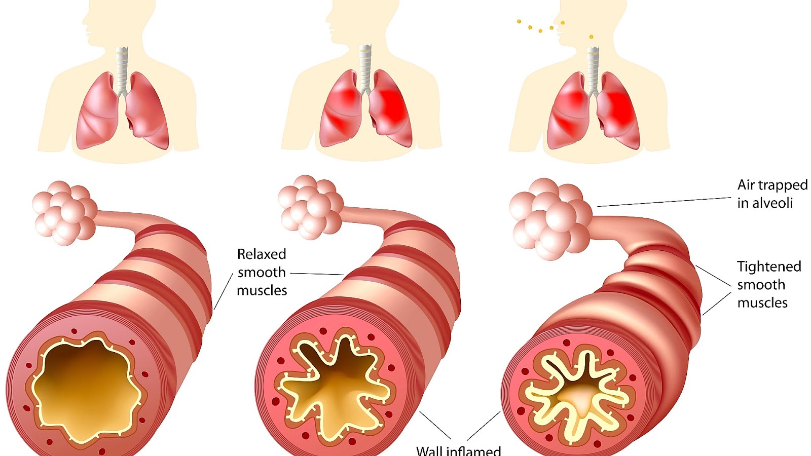 The Effects Of Asthma Effect Choices