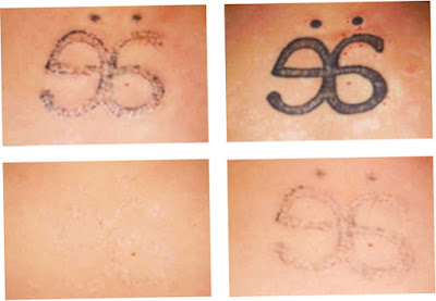 Tattoo Removal With Laser Picture 1 Best