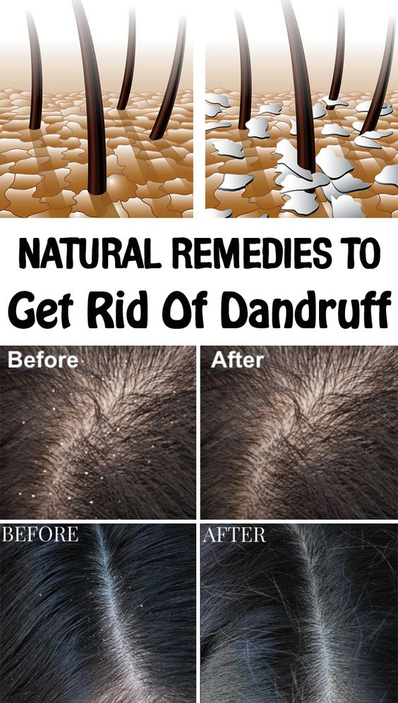 Natural remedies to get rid of dandruff Healthy Crown