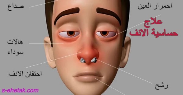 علاج حساسية الانف علاج حساسية الانف
