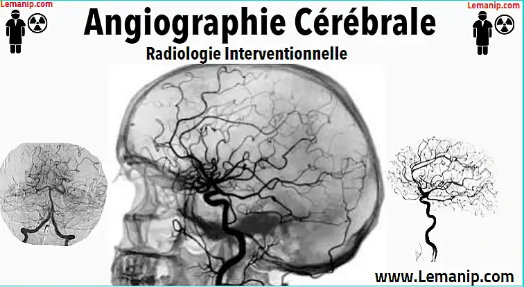 Angiographie Cérébrale Radiologie Interventionnelle