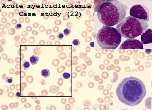 case study of acute myeloid leukemia