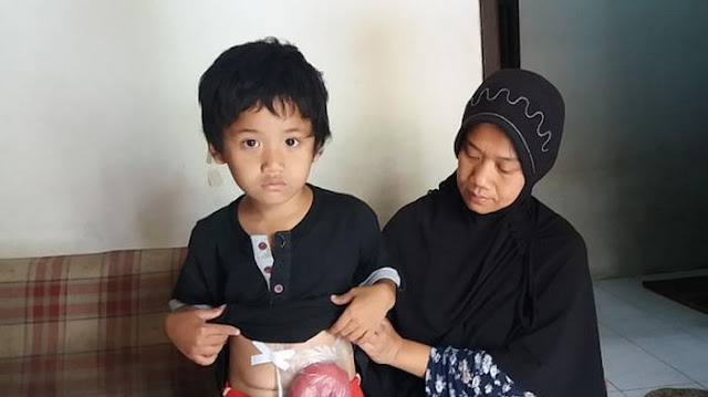 Yusa, Bocah 6 Tahun ini Hidup dengan Usus Diluar Perut Dibungkus Plastik Selama 6 Bulan Yusa, Bocah 6 Tahun ini Hidup dengan Usus Diluar Perut Dibungkus Plastik Selama 6 Bulan