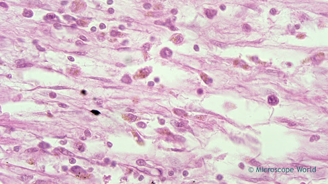 Microscopy image of a heart attack (myocardial infarction) under the microscope at 400x.