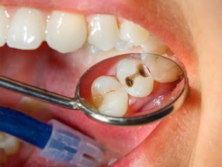 Răng dễ bị sâu khi nào? 