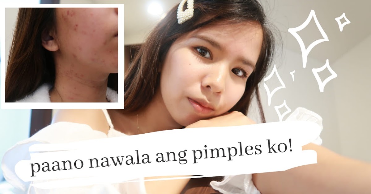 Carmela Kanda How I cleared my hormonal acne Fish oil)