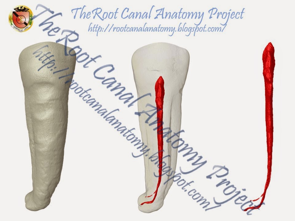The Root Canal Anatomy Project: Mandibular First Premolar: Two Root Canals